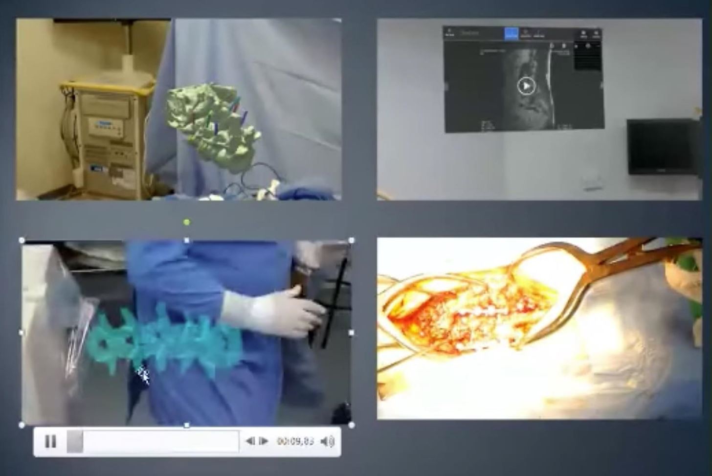 Doctors Use 3D Holograms on the HoloLens to Aid in Collarbone Repair During Surgery